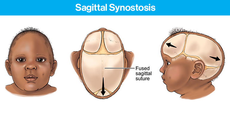 Sagittal Synostosis