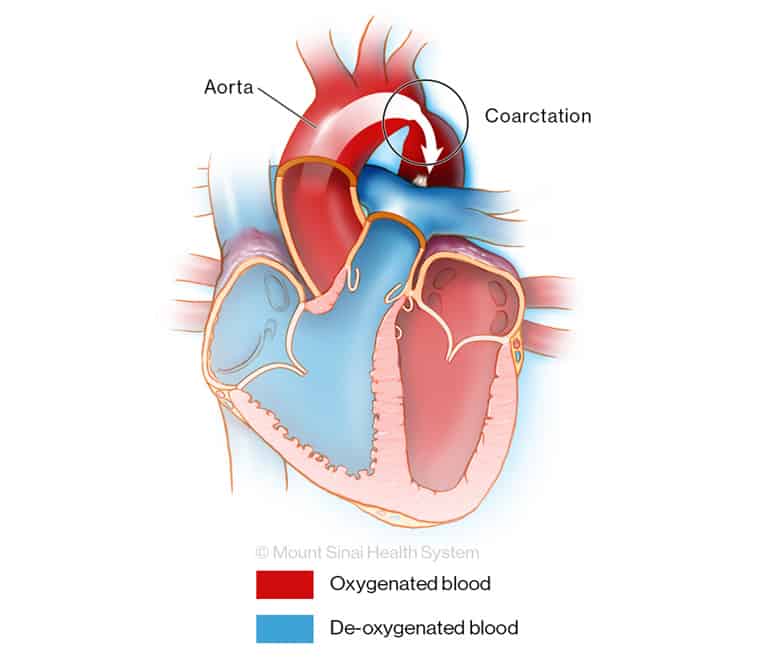 Narrowed aorta that slows oxygen flow to body illustration