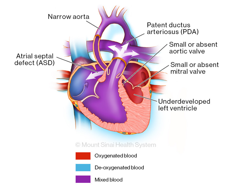 Left heart syndrome illustration