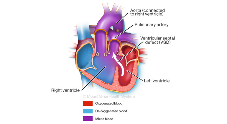 Illustration of DORV with subpulmonary VSD