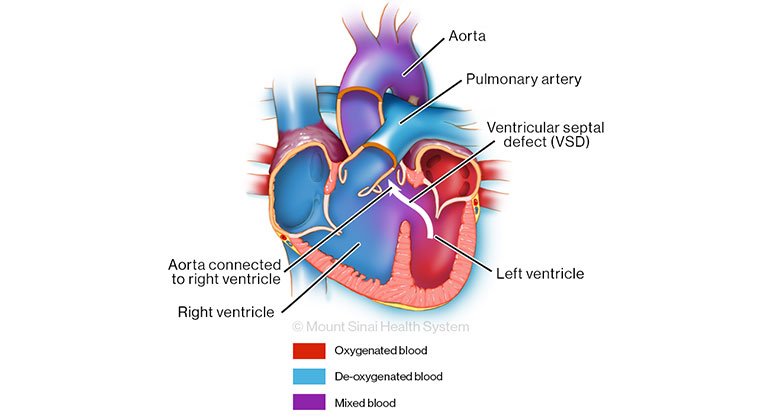 Illustration of Congenital Heart