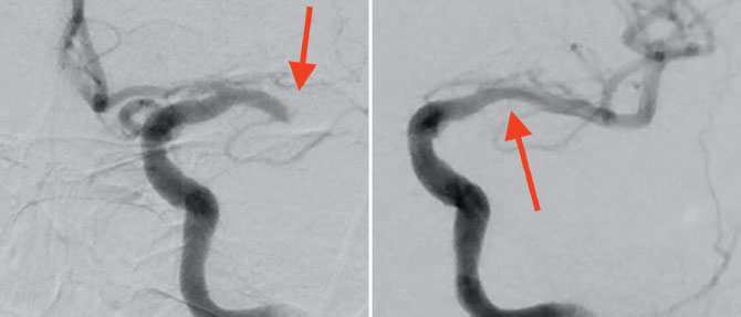 Two photos: Left, the initial diagnostic angiogram shows a left M1 occlusion. Right: the angiogram shows the clot has been removed and the vessel is recanalized.
