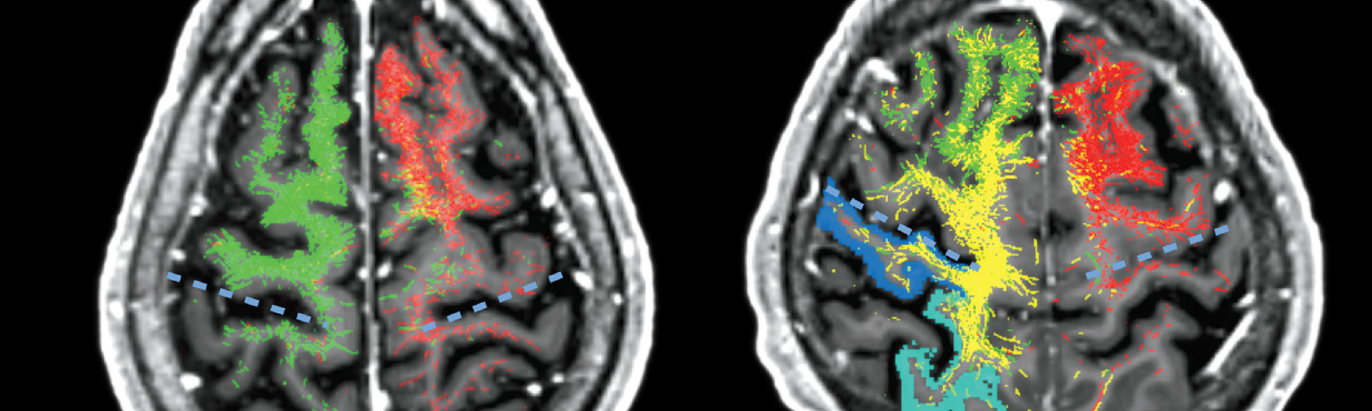 A comparison of the tractography from caudal zona incerta deep brain stimulation (DBS) in Patient 1 (responder) and Patient 2 (non-responder). It can be appreciated that electrode stimulation in both patients project to similar areas of the frontal cortex, particularly the motor and premotor areas. 
