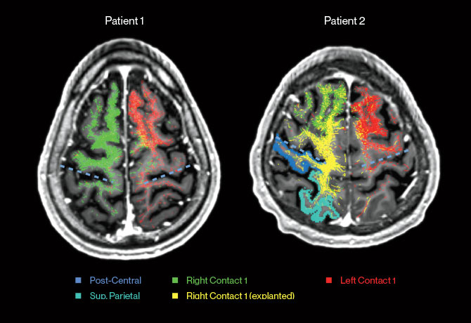 Images above show a comparison of the tractography from caudal zona incerta deep brain stimulation