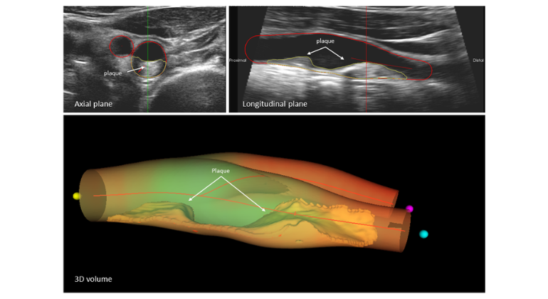 Atherosclerosis