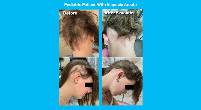 alopecia patient