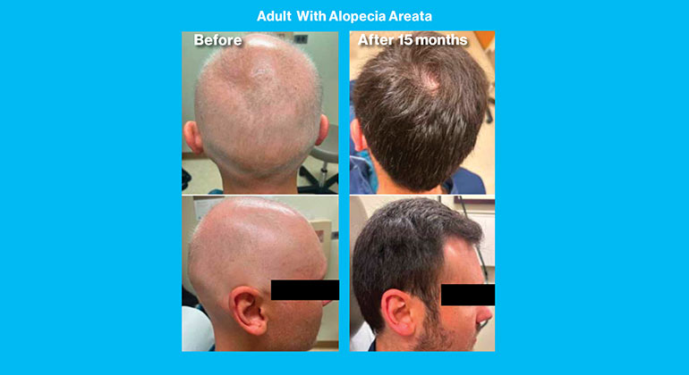 Alopecia Areata images