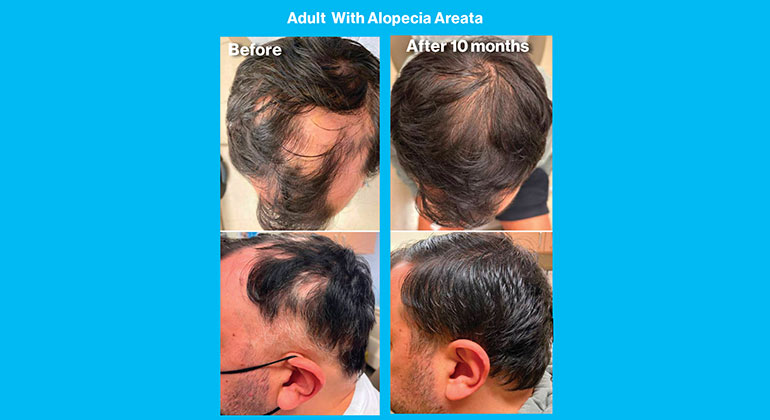Alopecia Areata images