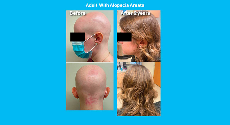 Alopecia graphic