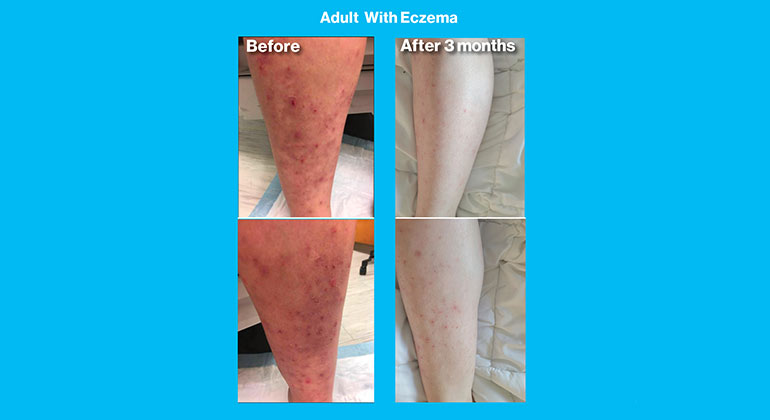 eczema patient