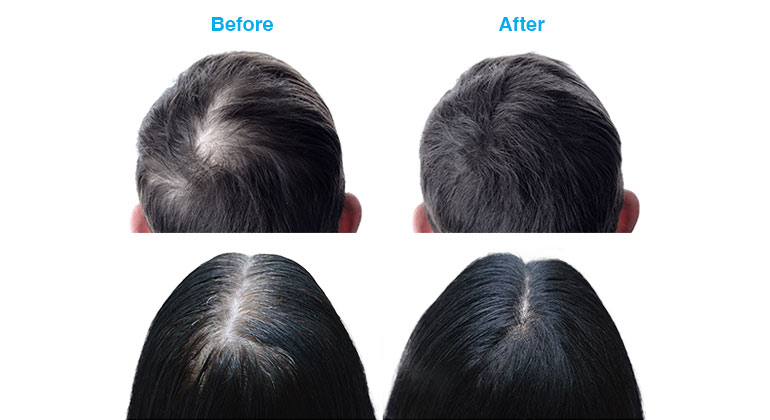 image of hair loss examples