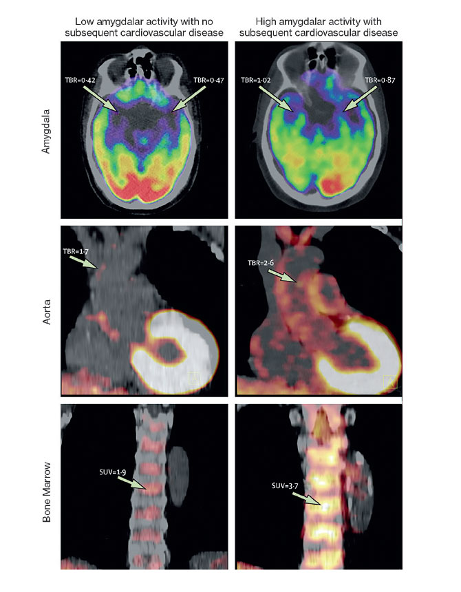 Axial views of the amygdala, coronal views of the aorta, and coronal views of bone marrow