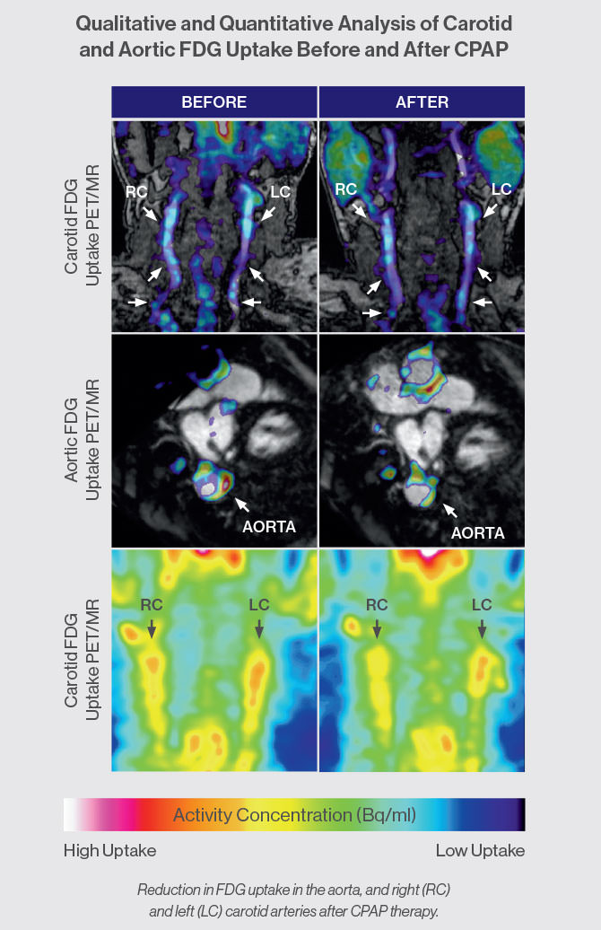 A series of images shows reduction in FDG uptake in the aorta, and right (RC) and left (LC) carotid arteries after CPAP therapy.