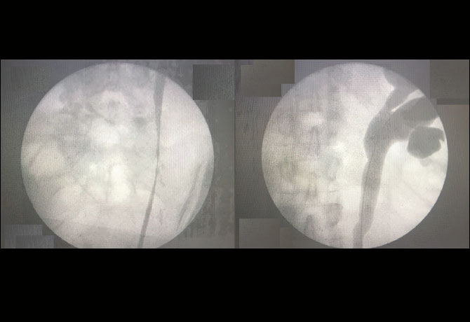 Two images including a preoperative cystoscopy image depicting left proximal ureteral stricture and, right, showing evidence of hydroureteronephrosis.