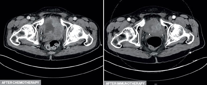 Two images show after chemotherapy, top, the tumor was still large and invasive; after immune checkpoint inhibitor, the tumor was smaller and more confined to the bladder.