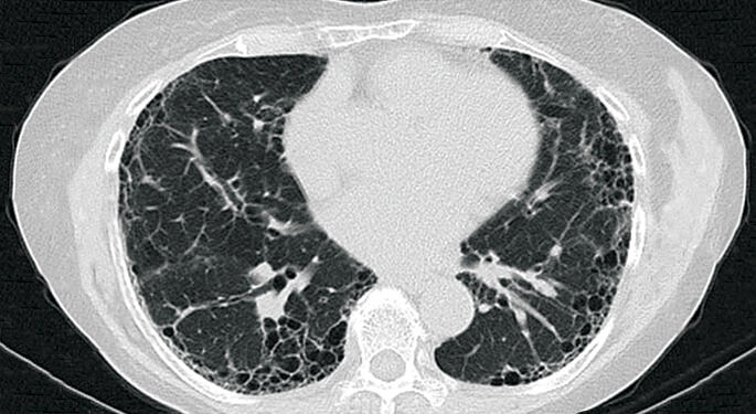 Nontuberculous mycobacteria lung disease